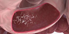 Použitie trojíc na odstránenie parazitov