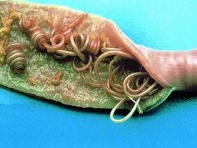 Príčiny parazitov v ľudskom tele