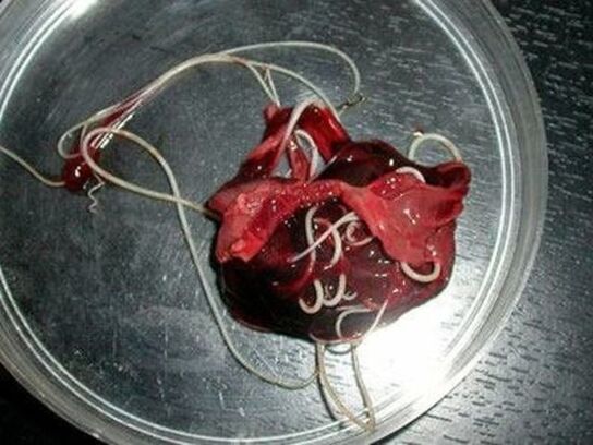 červy z ľudského tela